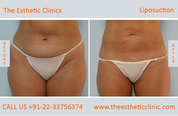 Liposuction Fat Removal Treatment before after photos in mumbai india (1)